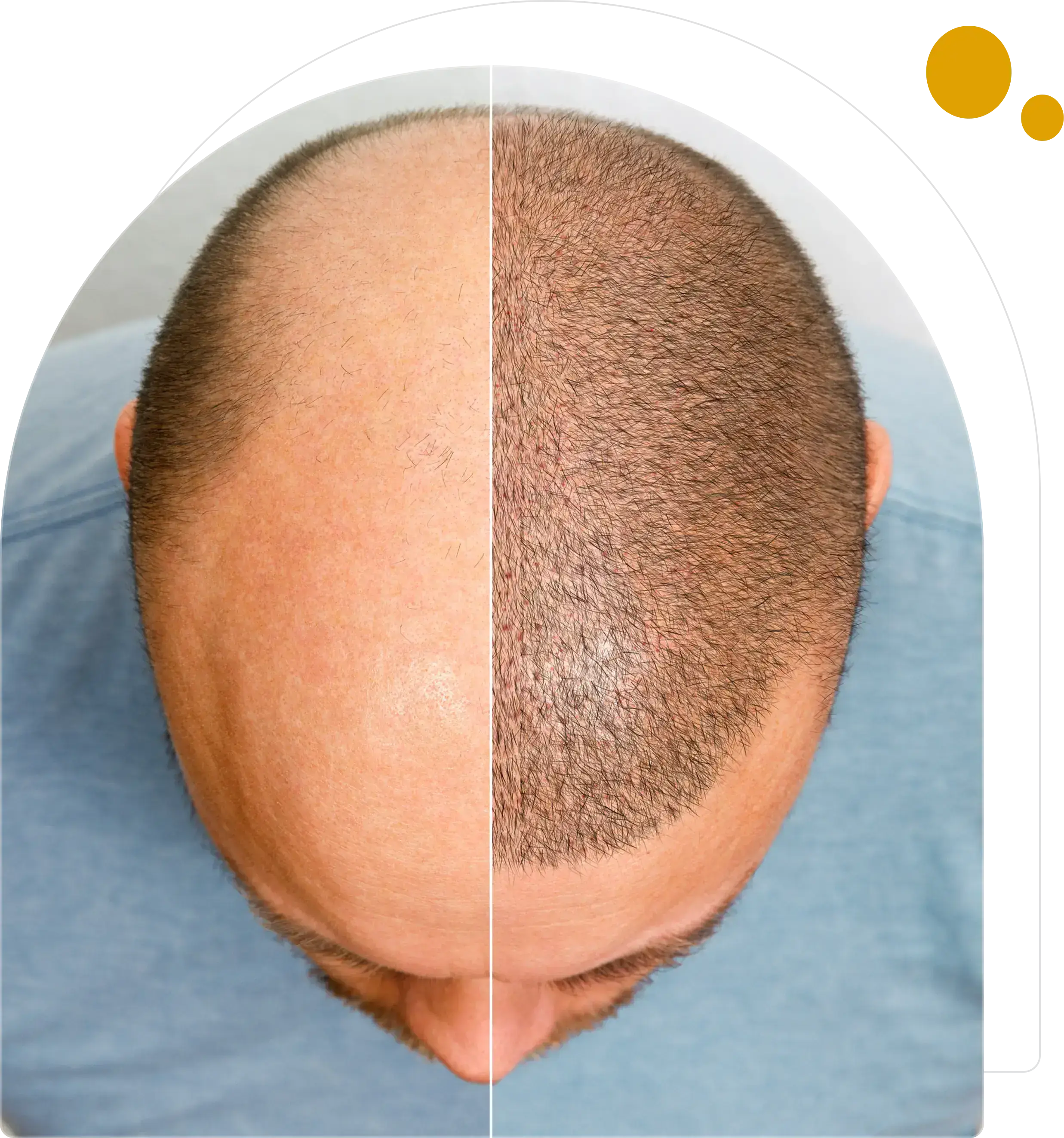 Before and after hair transplant showing restored hairline.