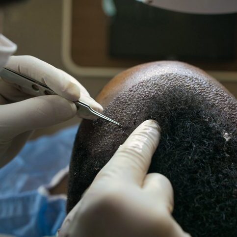 A doctor performing a hair transplant on a patient's scalp.