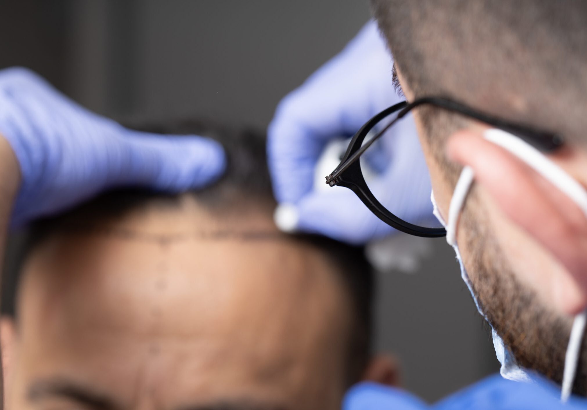 A doctor marks a patient's scalp before hair transplant surgery.