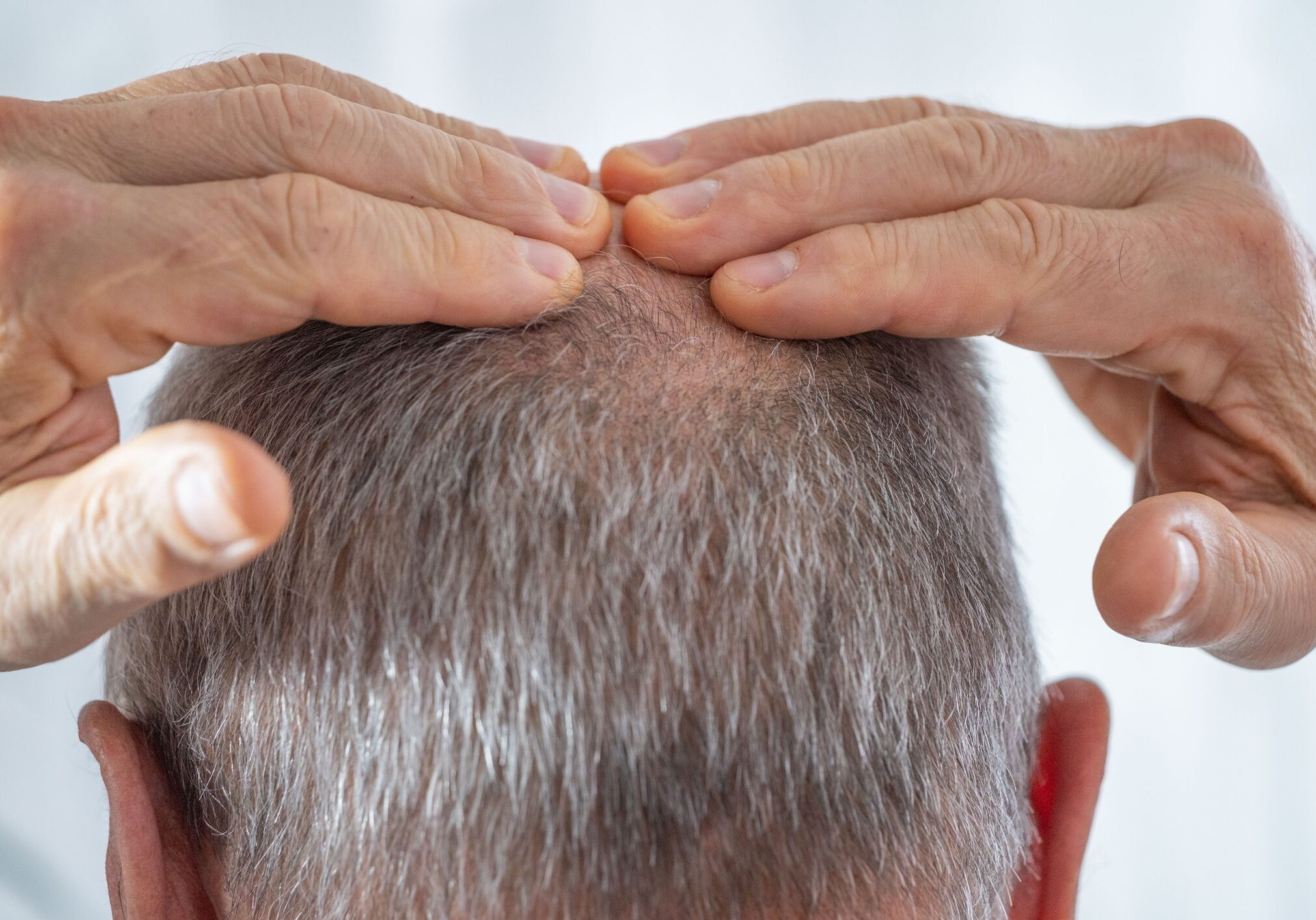 Hands examining a balding scalp on the back of a man's head.