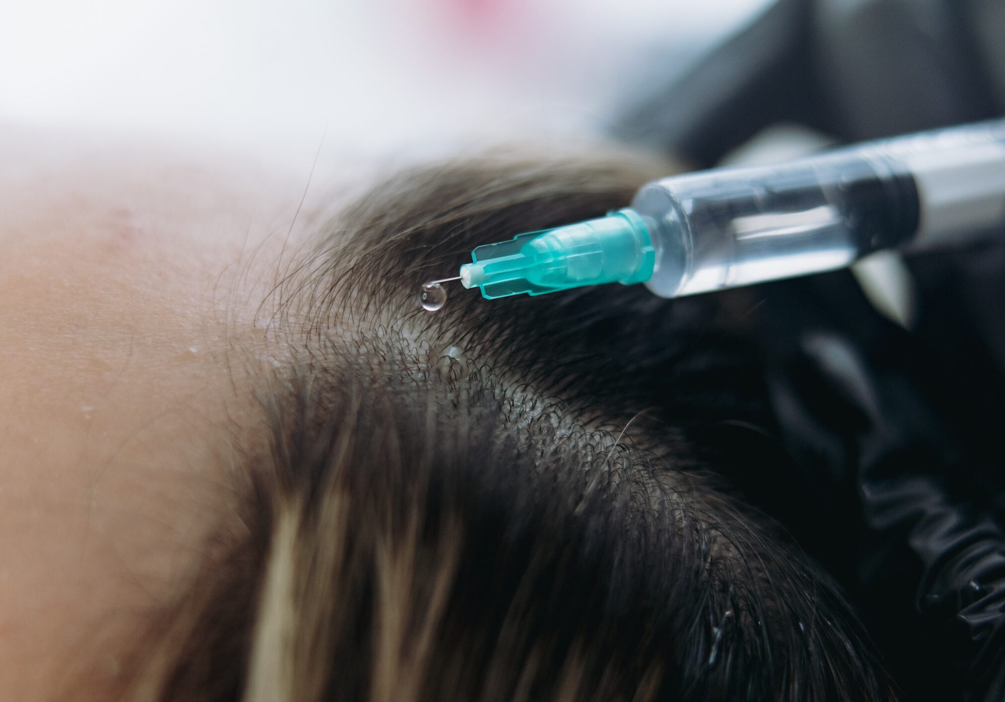 Close-up of a scalp receiving an injection with a syringe.