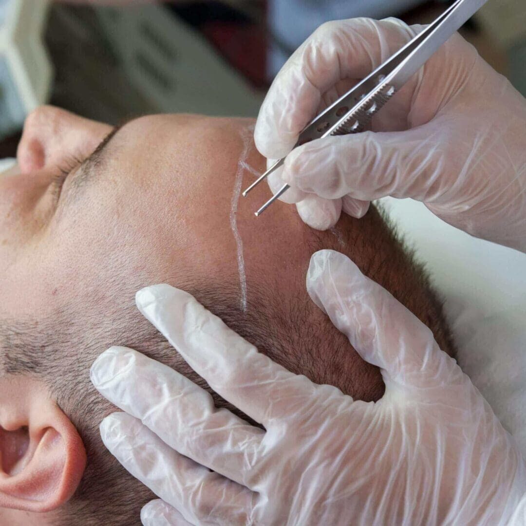 Gloved hands placing hair grafts along hairline